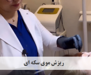 ریزش موی سکه ای
