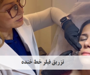 تزریق فیلر خط خنده