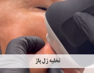 تخلیه ژل پاژ | دکتر ژیلا عبدی