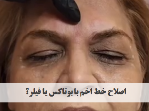 اصلاح خط اخم