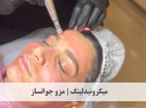 میکرونیدلینگ | مزو جوانساز | دکتر ژیلا عبدی