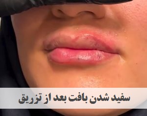 سفید شدن بافت لب | فیلر | تزریق فیلر | دکتر ژیلا عبدی | پزشک زیبایی تهران | دکتر پوست و مو تهران | ونک | ملاصدرا