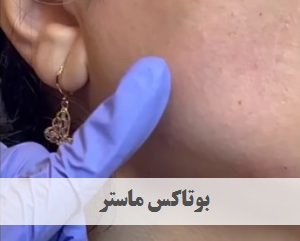 بوتاکس ماستر | دکتر ژیلا عبدی | پزشک زیبایی تهران | دکتر پوست و مو تهران | ونک | ملاصدرا