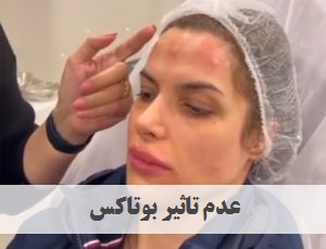 عدم تاثیر بوتاکس | دکتر ژیلا عبدی | پزشک زیبایی تهران | دکتر پوست و مو تهران | ونک | ملاصدرا | بهترین دکتر پوست و مو و زیبایی تهران